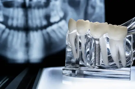 A titanium dental implant with ceramic crown displayed beside a brass measuring caliper